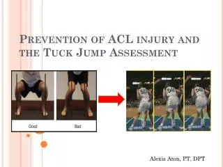 Prevention of ACL injury and the Tuck Jump Assessment