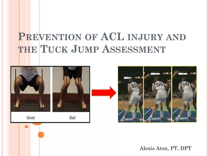 prevention of acl injury and the tuck jump assessment