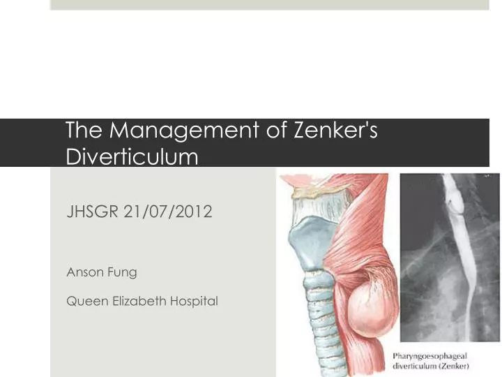 the management of zenker s diverticulum