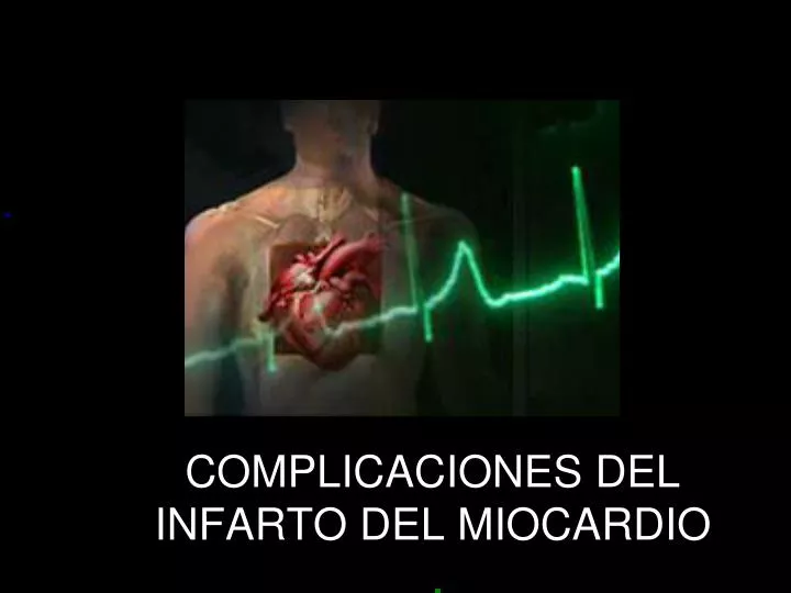 complicaciones del infarto del miocardio