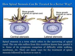 Treatment of Spinal Stenosis