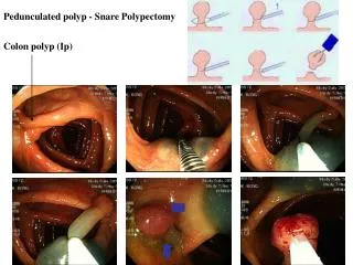 Colon polyp (Ip)