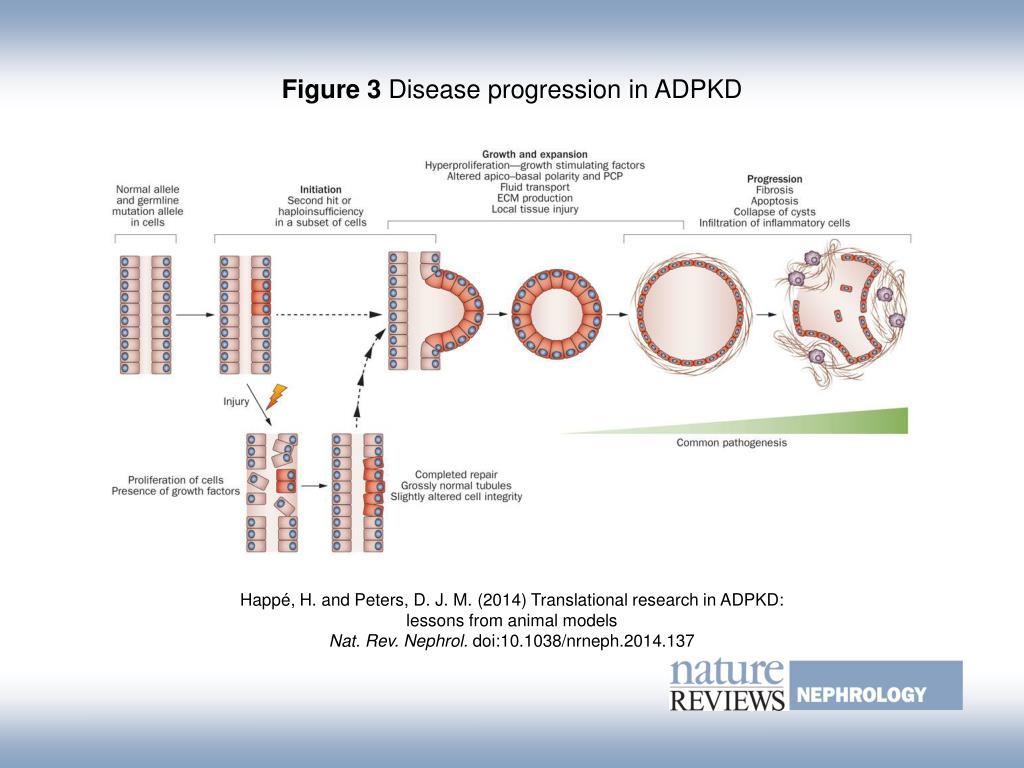 PPT - Figure 3 Disease progression in ADPKD PowerPoint Presentation ...