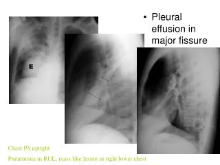 Pleural effusion in major fissure