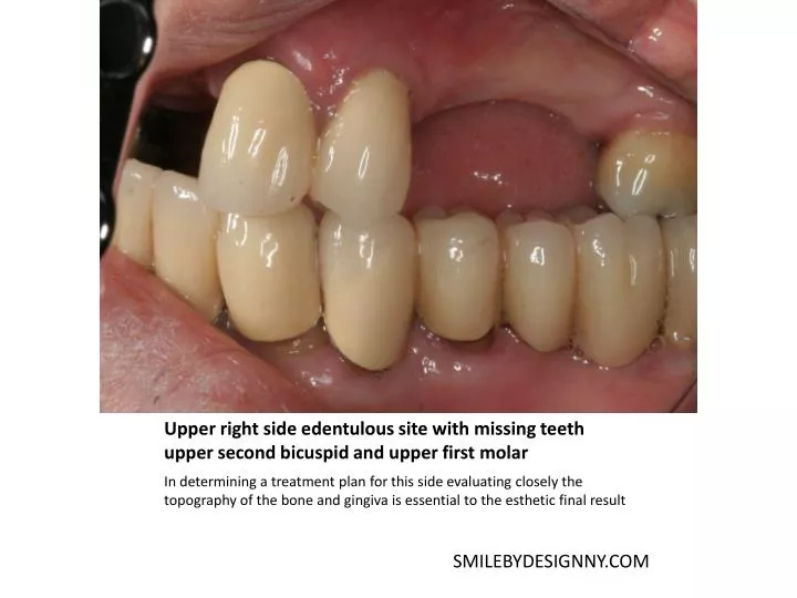 upper right side edentulous site with missing teeth upper second bicuspid and upper first molar