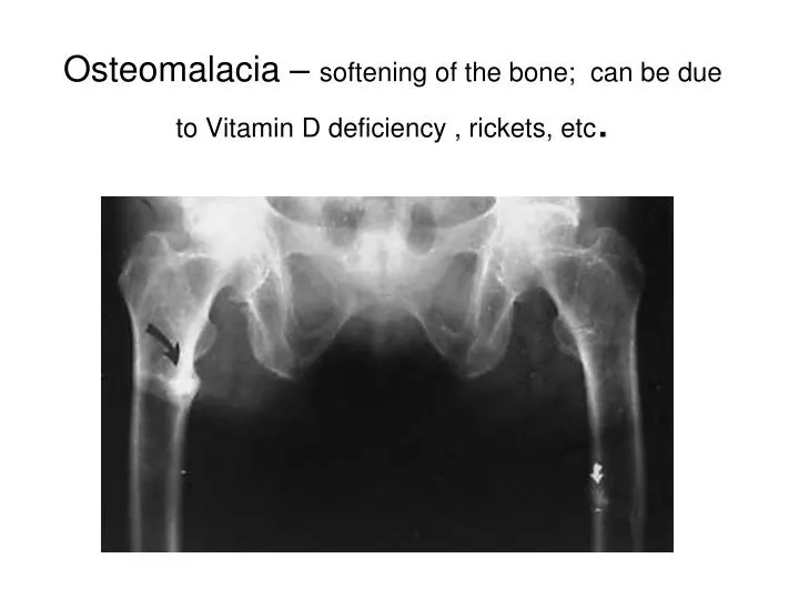 osteomalacia softening of the bone can be due to vitamin d deficiency rickets etc