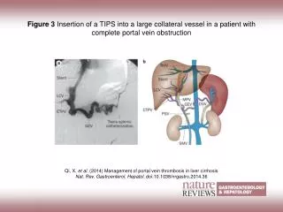 Qi, X. et al. (2014) Management of portal vein thrombosis in liver cirrhosis