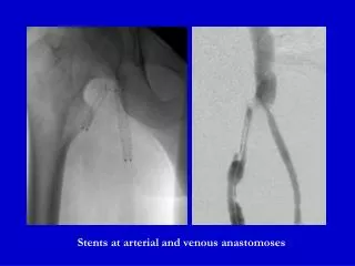 Stents at arterial and venous anastomoses