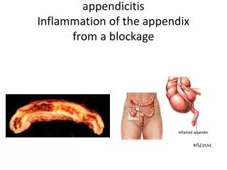 appendicitis Inflammation of the appendix from a blockage