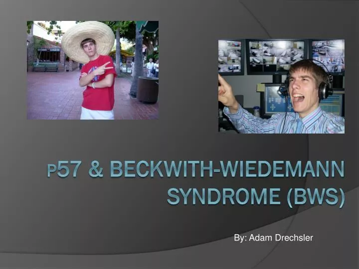 p 57 beckwith wiedemann syndrome bws