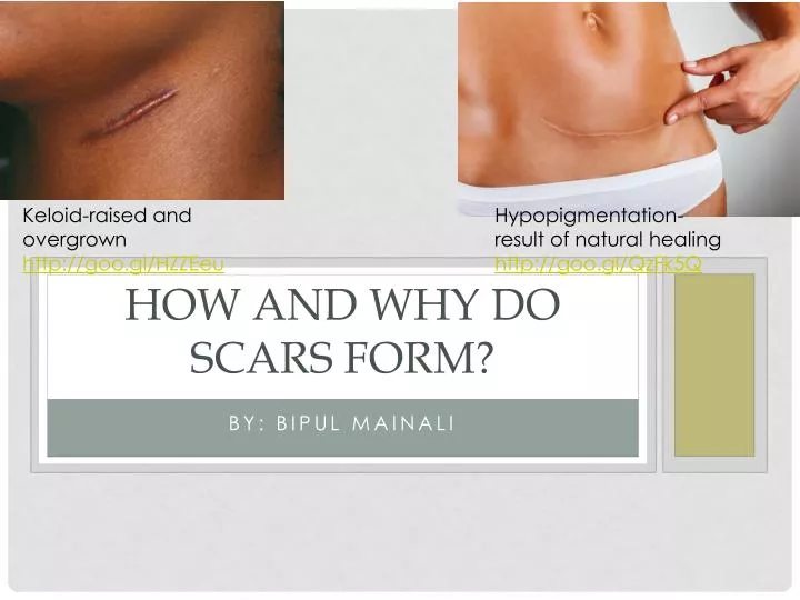 how and why do scars form