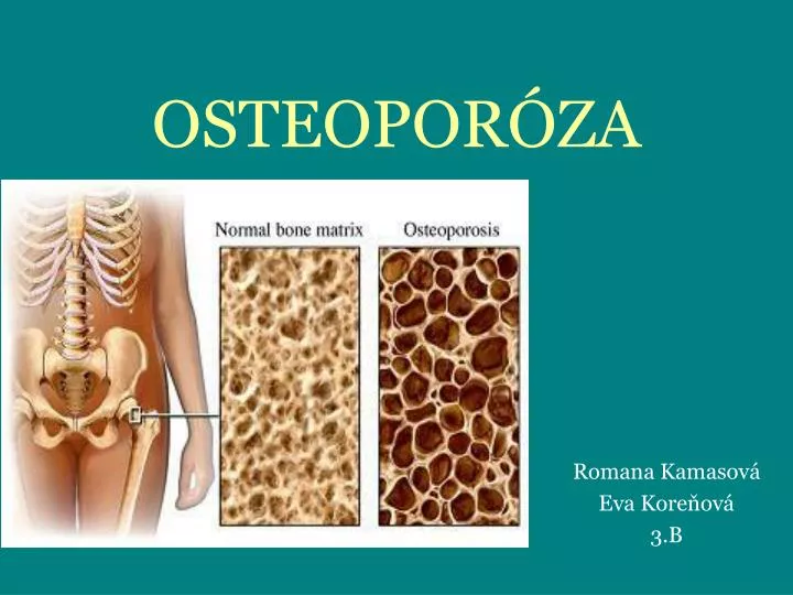 osteopor za