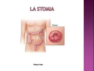 la stomia