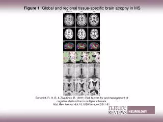 Figure 1 Global and regional tissue-specific brain atrophy in MS