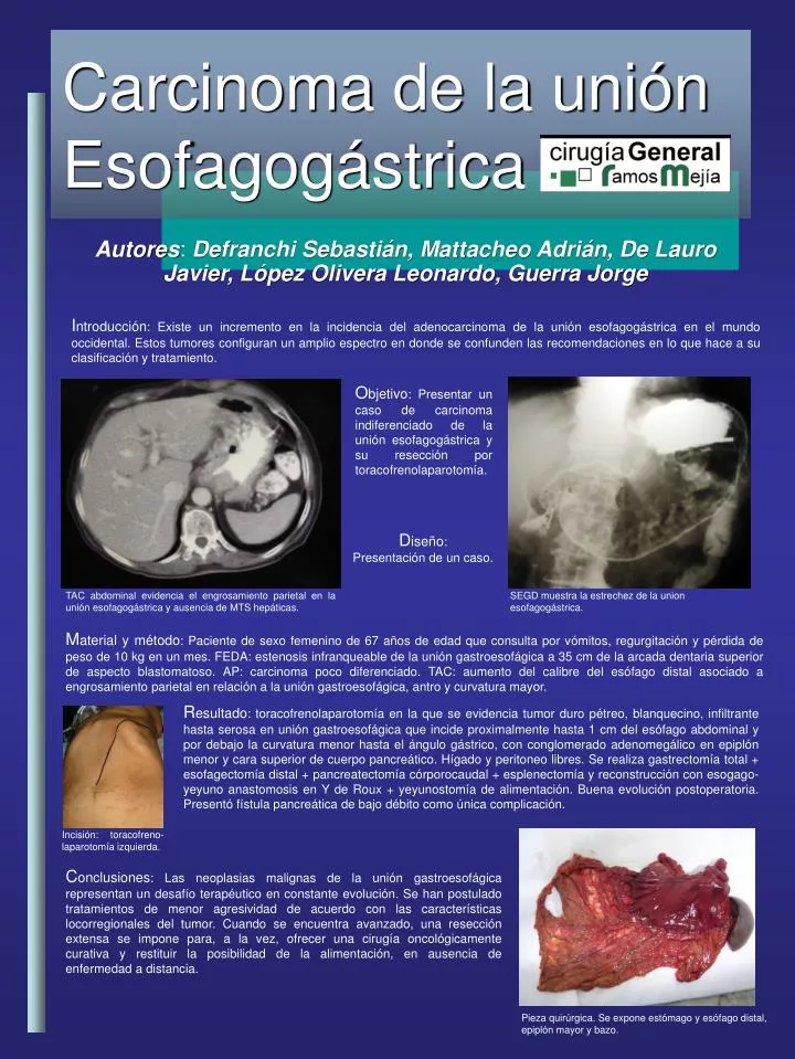carcinoma de la uni n esofagog strica