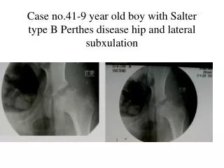 Case no.41-9 year old boy with Salter type B Perthes disease hip and lateral subxulation
