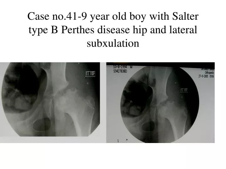 case no 41 9 year old boy with salter type b perthes disease hip and lateral subxulation